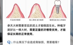 种牙植骨后骨头完全长成需要多长时间？