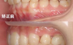 前牙深覆盖 正畸