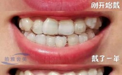 上海隐形矫正牙齿费用多少？效果和医院怎么选？