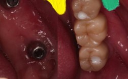 种牙后出现不良反应怎么办？