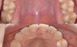 牙齿矫正下牙齿不齐，矫正后没改善怎么办？