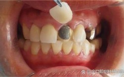 牙齿矫正托槽部分掉落，是什么原因导致的？