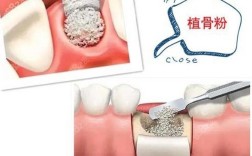 牙植自体骨效果如何？优势与风险有哪些？