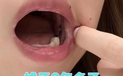 拔牙后隔2年种牙行吗