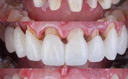 全瓷冠桥修复和种牙有何区别？牙齿缺失选哪个好？