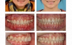 牙齿矫正后咬合太深，是什么原因导致的？该如何有效处理？