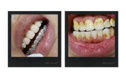 隐形牙齿矫正会有哪些常见后遗症？