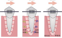 正畸牙齿移动原理