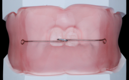 正畸支抗颊面管在矫正中有什么重要作用？