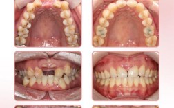 单晶 正畸 不好