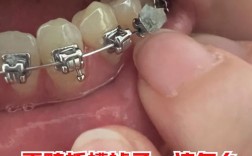 正畸结束如何摘托槽