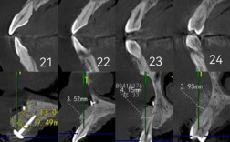 paoo手术中，正畸医生的参与是否为治疗过程中不可或缺的一环？