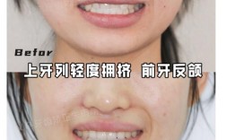 矫正后牙齿为何还不齐？