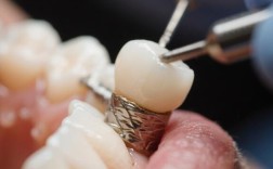 镶牙之后，为何需要换种牙？