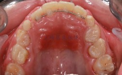 牙齿正畸把牙拉出来