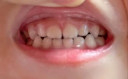 正畸导板晚上戴不戴