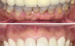 牙齿矫正烤瓷牙图片效果如何？真实案例能参考吗？