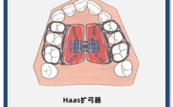正畸扩弓有几种方法？哪种更适合不同情况？