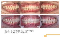 南京牙齿矫正正畸如何选择不踩坑的靠谱医院和医生呢？