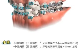天包地牙齿矫正有哪些常用方法？