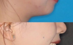 一颗大牙往外突影响美观，正畸矫正能改善吗？