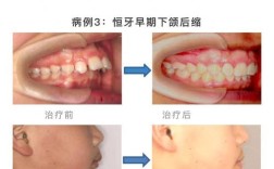 口腔正畸偏颌容易复发