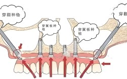 需要植骨种牙的手术步骤