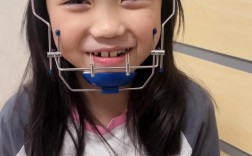 乳牙反颌锻炼方法