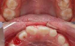 兰州市牙齿矫正