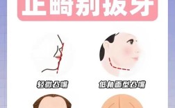 正畸不拔牙vs拔牙，到底该怎么选？效果差异大吗？