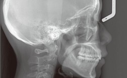 牙齿矫正为何要做头颅侧位？它对矫正方案有何关键意义？