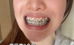 矫正牙齿为何会引发牙敏感？如何有效缓解？