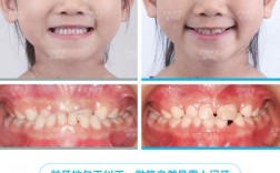 幼儿地包天矫正何时开始最合适？家长必知的方法与时机