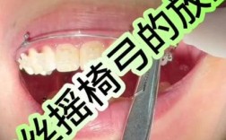 正畸摇椅弓怎么弯？关键步骤与实用技巧详解