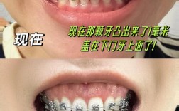 牙齿矫正后多久能看到明显变化？