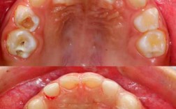 成人矫正牙齿后，美容冠有必要吗？效果如何？