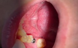 牙齿少一颗种牙