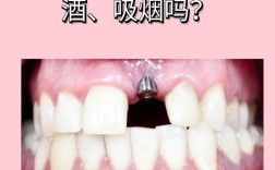 种牙多久不能喝啤酒