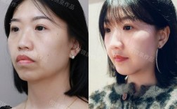 牙齿矫正能代替突嘴手术吗？