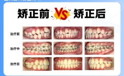 矫正牙齿不反弹，真的能实现吗？