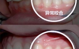 确定咬合的方法