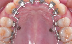 正畸方形勾托槽