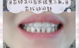 矫正牙齿会让牙齿变黑吗？