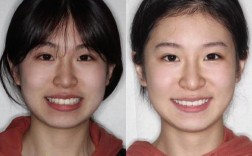 杭州龅牙正畸哪里好