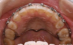 正畸横腭杆需要佩戴多久？时长因人而异吗？