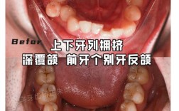正畸不拔牙可以吗