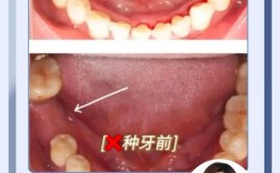植牙后多久能彻底愈合？愈合周期一般需要多久？