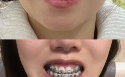 矫正牙齿一年后怀孕，对牙齿矫正效果和胎儿健康有影响吗？