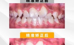 正畸下排牙齿向右倾斜是什么原因？