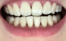 矫正牙齿后为何有黑三角？原因和解决方法